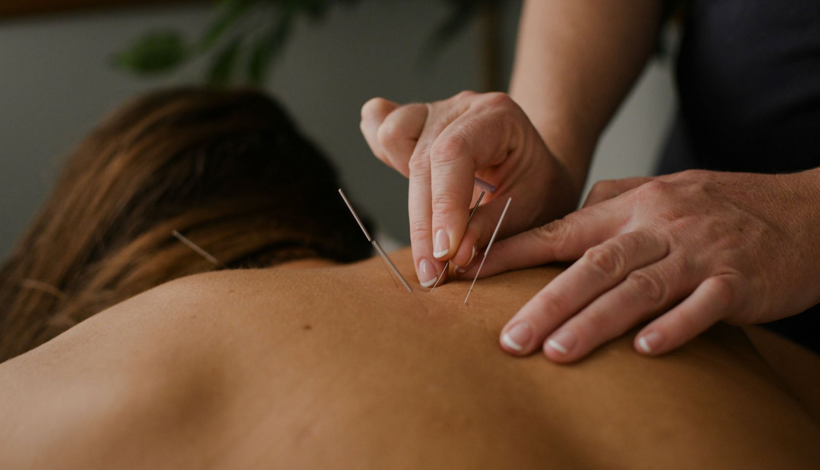 acupuncture-services